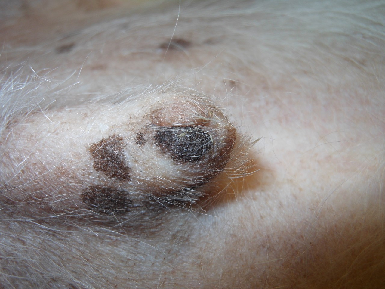 Image Gallery: Primary Skin Lesions | Clinician's Brief